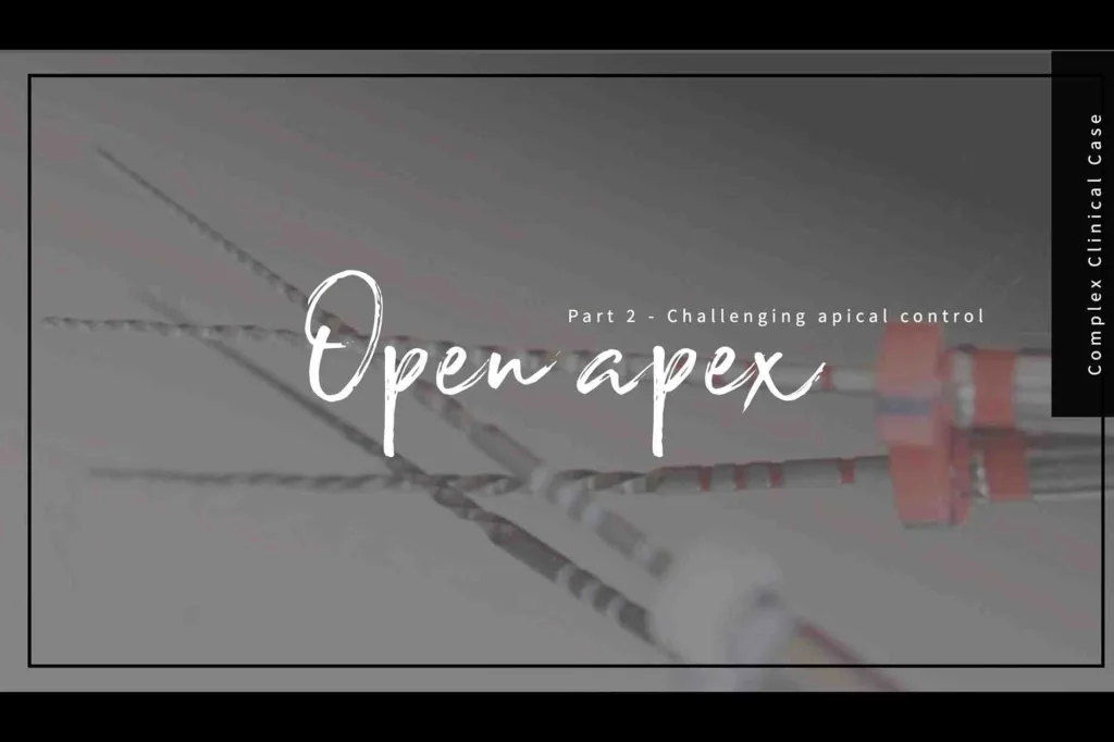 Open apex complex clinical case thumbnail