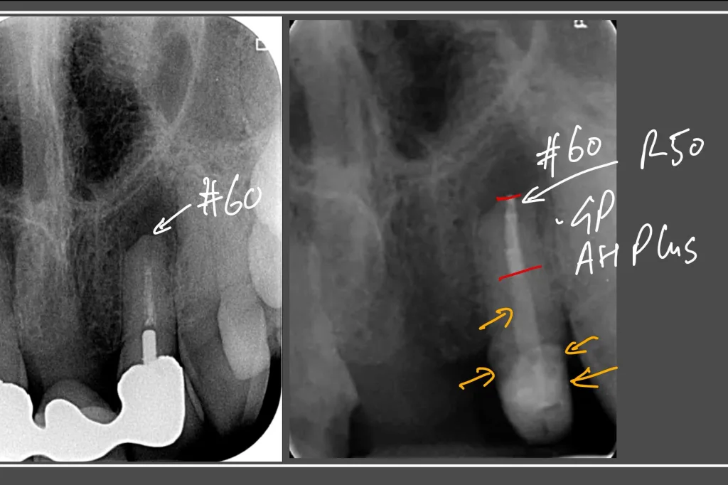 Endo and Anterior Bridge Thumbnail