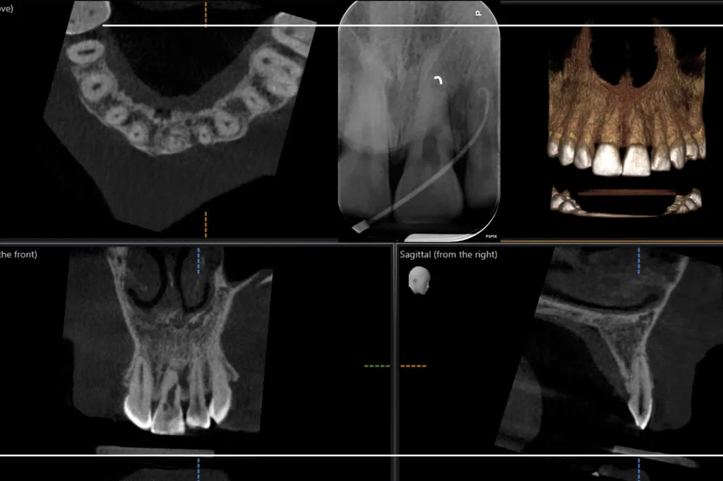 Upper anterior Resorption case thumbnail