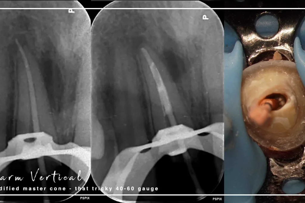 UR1 Endo Difficult Obturation and Vertical Margin Thumbnail