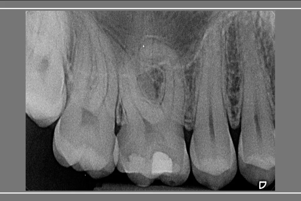 UR6 Endo and Direct Composite Thumbnail