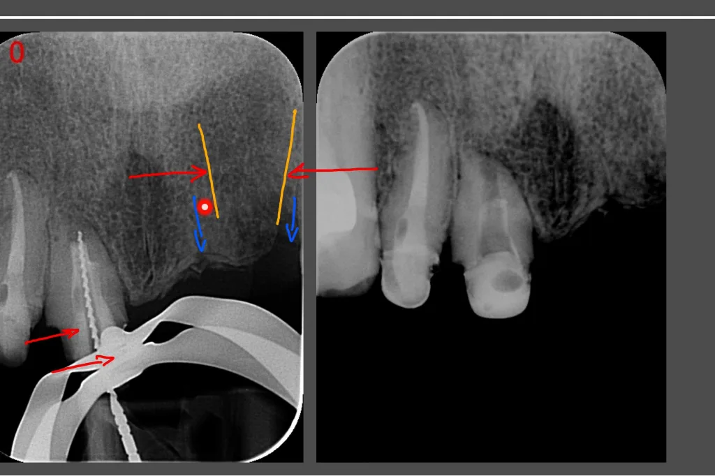 UR1 re RCT with large apex and large canal thumbnail
