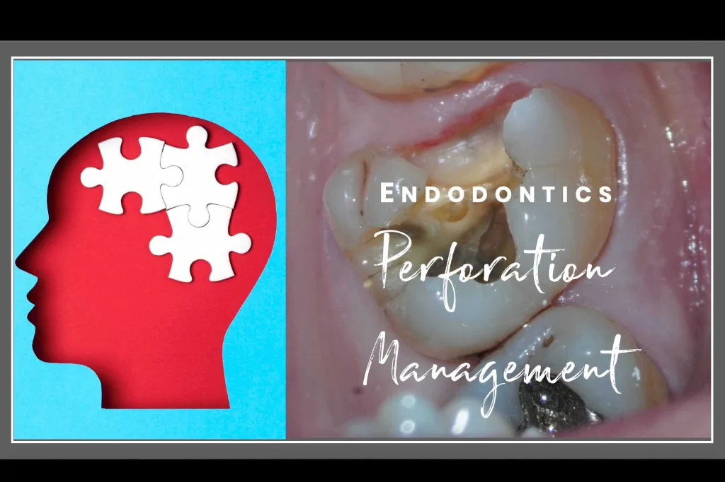 Perforation management Advanced techniques thumbnail