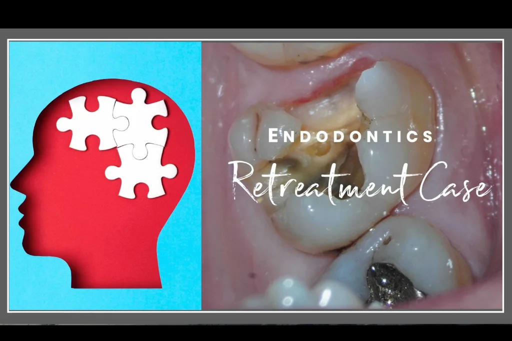 Retreatment Case thumbnail