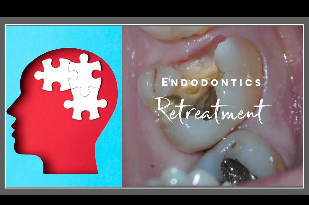 Retreatment clinical case