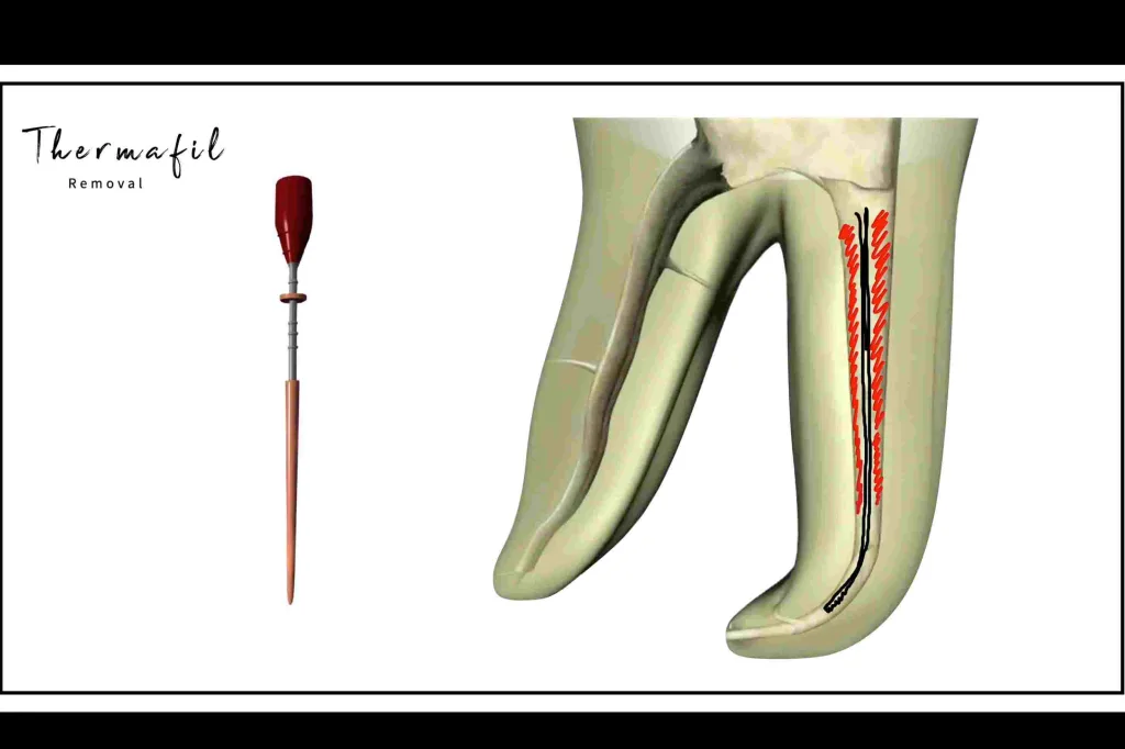 Thermafill removal thumbnail