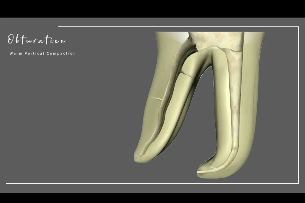 Obturation warm vertical compaction thumbnail