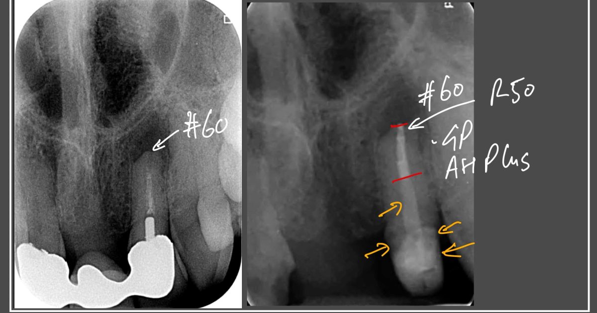 Endo and Anterior Bridge | Contemporary Endodontics