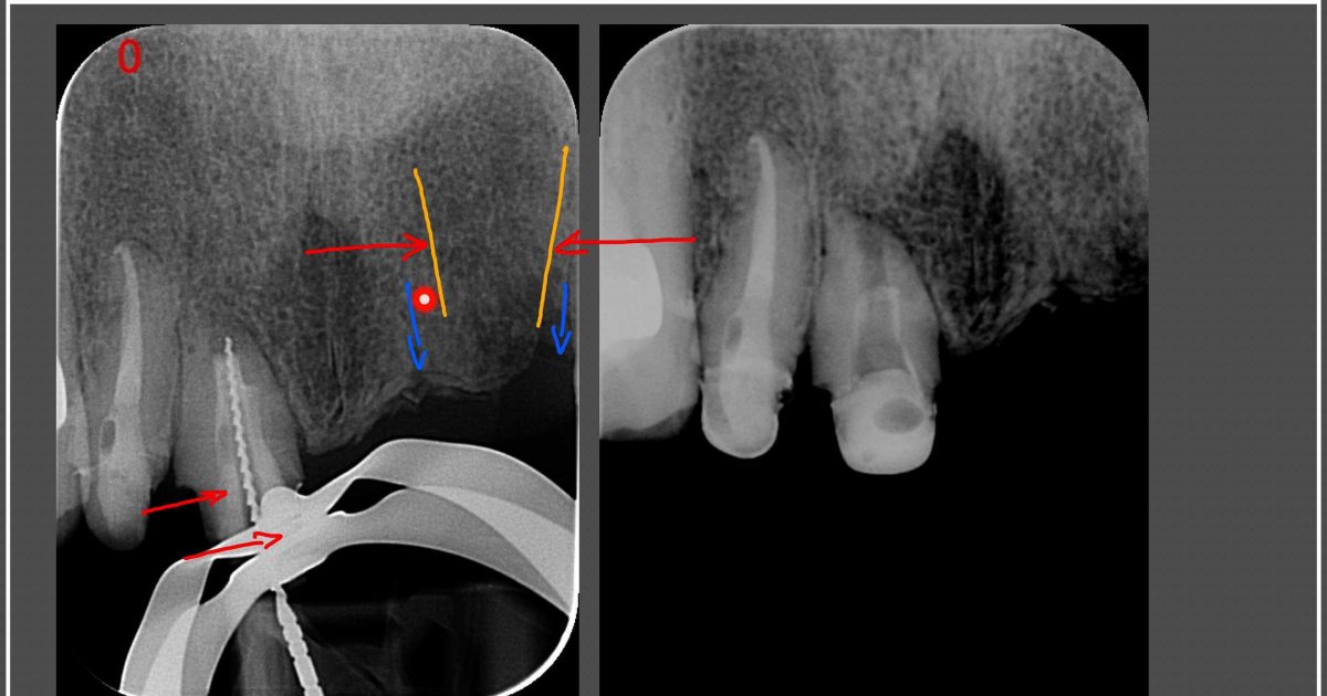 UR1 ReRCT: Large apex and large canal | Contemporary Endodontics