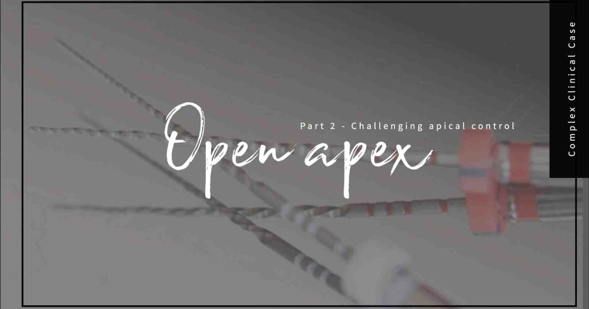 Open apex management: A complex clinical case | Contemporary Endodontics